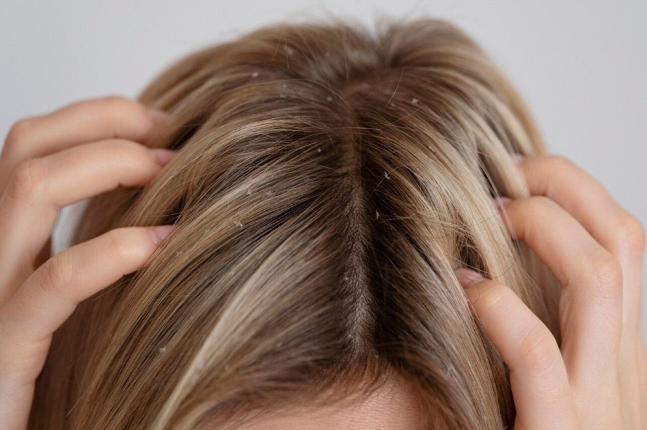 Πως να απαλλαγείτε απο τις ψειρες