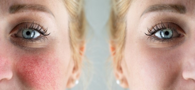 Ροδόχρους Ακμή: Συμπτώματα, Αίτια και Ολοκληρωμένη Φροντίδα